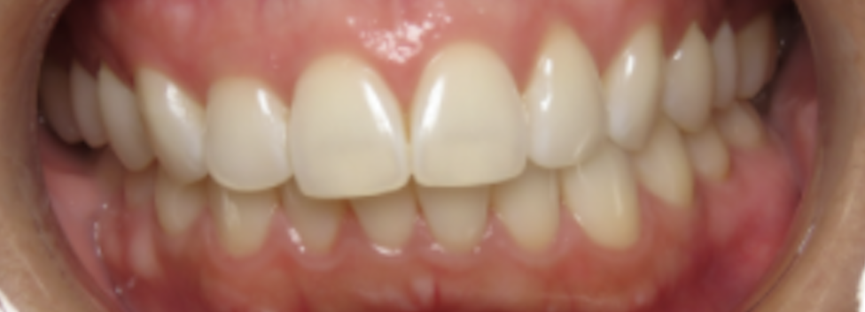 invisialign aligners sure smile scottsdale phoenix Arizona cosmetic dentist adult braces adult aligners before and after